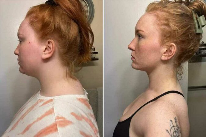 Incredible-photos-show-how-woman-banished-her-Dowagerx27s-neck-hump-and-you-can-too-The-Sun.jpg