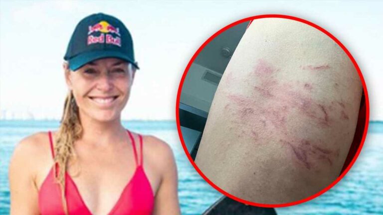 Lindsey-Vonn-Stung-By-Jellyfish-During-Wakesurfing-Session.jpg
