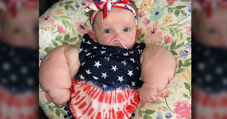 Tot-dubbed-as-Baby-Hulk-after-rare-condition-causes-huge-arms.jpg