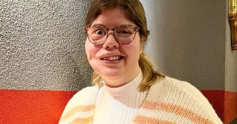 Bullies-call-me-Gollum-because-of-my-face-condition-–-but-I-know-Im-beautiful.jpg