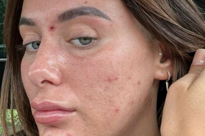 Millie-Court-shows-off-her-x27real-skinx27-in-make-up-free-snap-as-she-admits-shex27s-x27fed-upx27-over-acne-battle-The-Sun.jpg