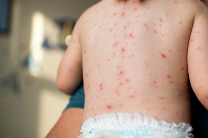Chickenpox-vaccine-set-to-be-offered-to-kids-on-NHS-in-major-change-to-jabs-programme-is-your-child-eligible-The-Sun.jpg