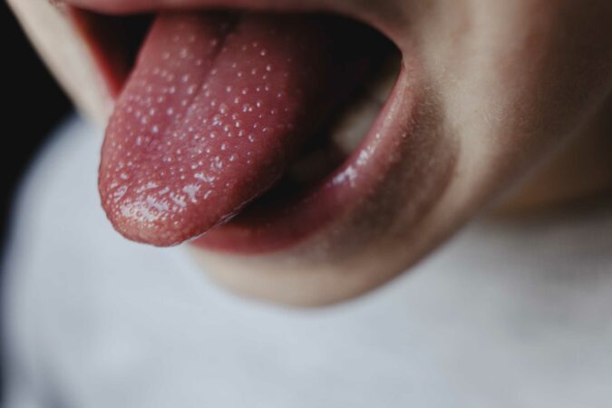 Fears-of-outbreak-grow-as-scarlet-fever-cases-double-in-part-of-the-UK-map-reveals-worst-hit-areas-The-Sun.jpg
