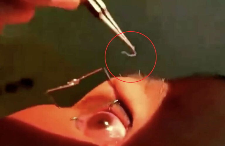Moment-doctors-pull-60-live-WORMS-from-womanx27s-eyes-in-stomach-churning-op-after-she-x27felt-a-bit-itchyx27-The-Sun.jpg